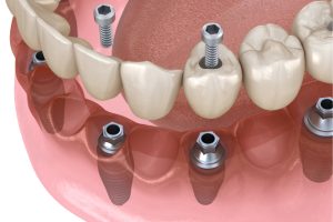 08-implant-ustu-protezler