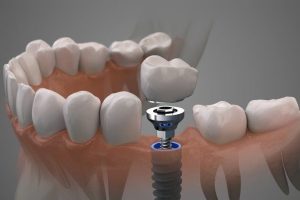 Dental Implants