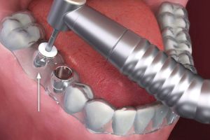 dikissiz-implant-tedavisi-nedir